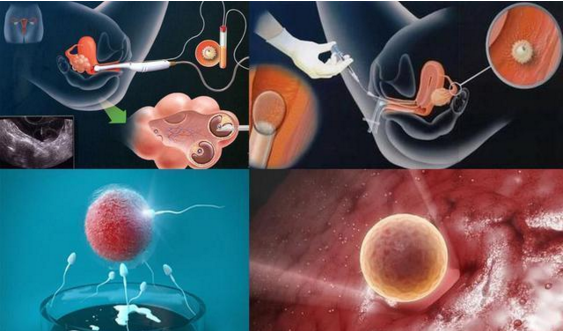 精子质量很差做人工授精成功率分析，附成功